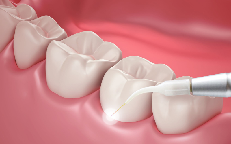 Periodontologinis gydymas